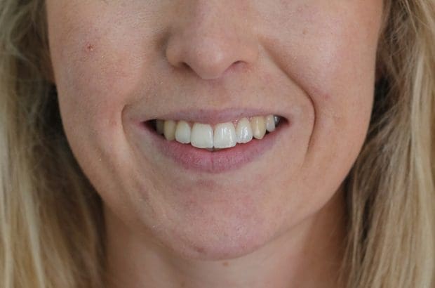 Clear Ceramic Braces Before and After