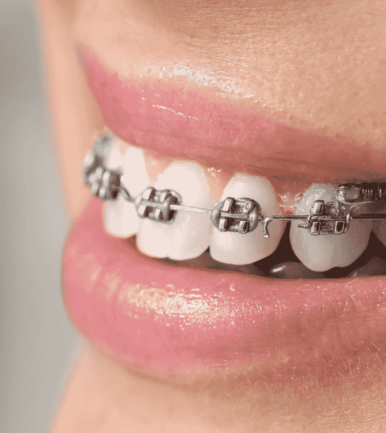 Types of Dental Braces West Sussex