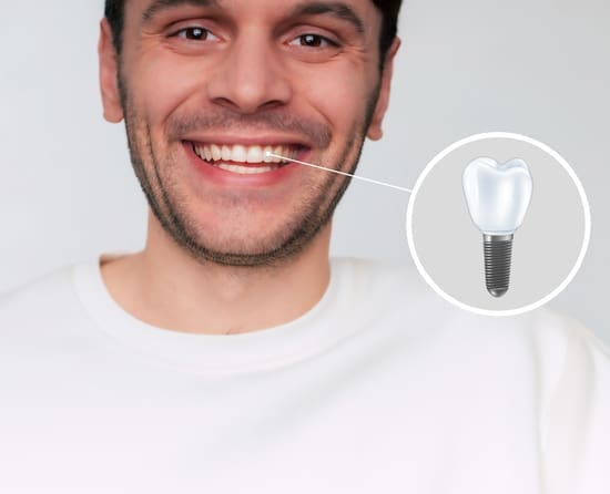 Dental Implants